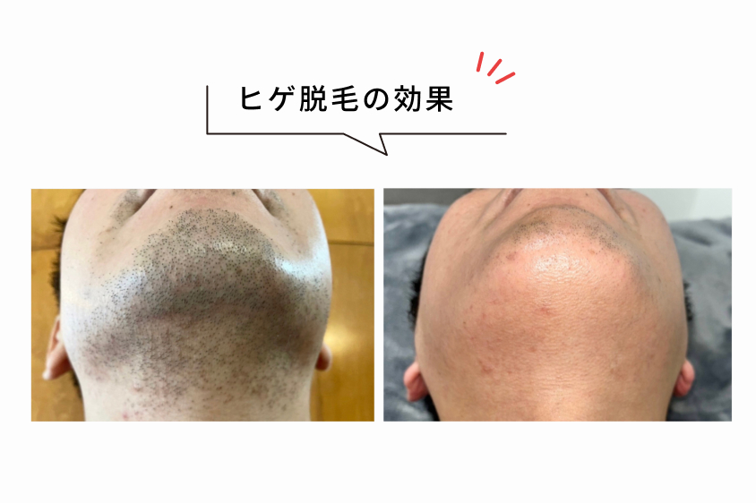 実績のある脱毛効果